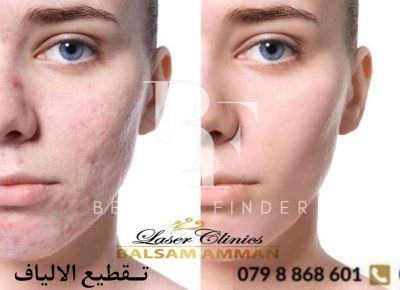 Balsam Amman Laser Clinic, top Laser Treatments Salon from Jordan, Beauty Finder - 4